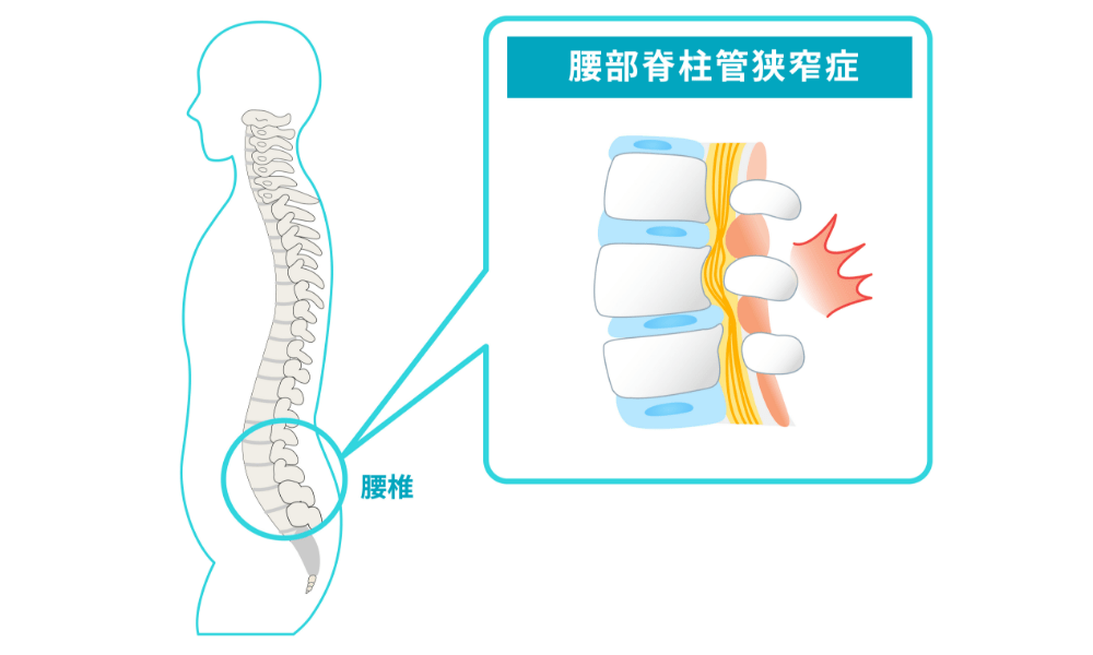 腰部脊柱管狭窄症