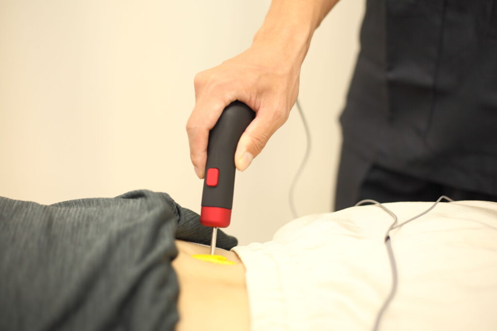 富山ウェルネス接骨院でこむら返りの治療風景