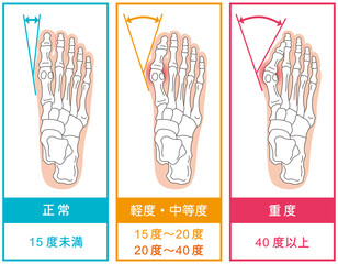 外反母趾の分類